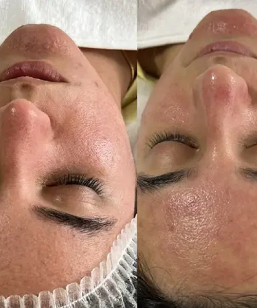 فیشیال پوست - الهام احمد جانی